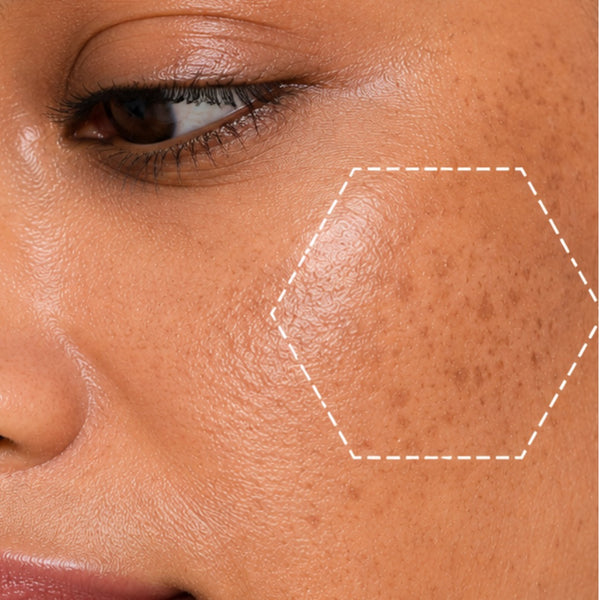 Dullness & Pigmentation