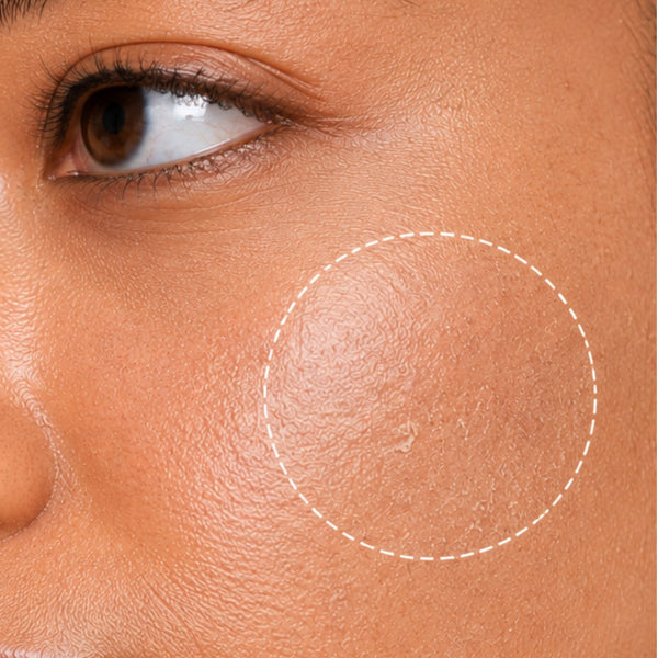Dryness & Barrier Repair