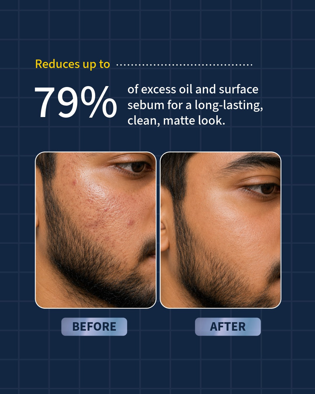 2% Zinc PCA Deep Pore Acne Control Cleanser for Blemish-Prone Skin - 100ml