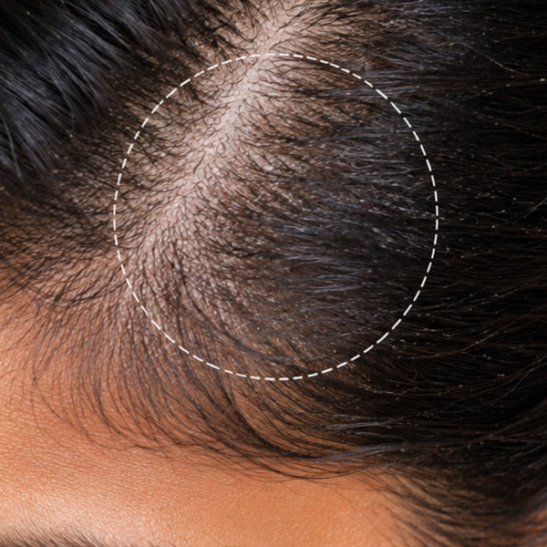 Hairfall & Scalp Buildup
