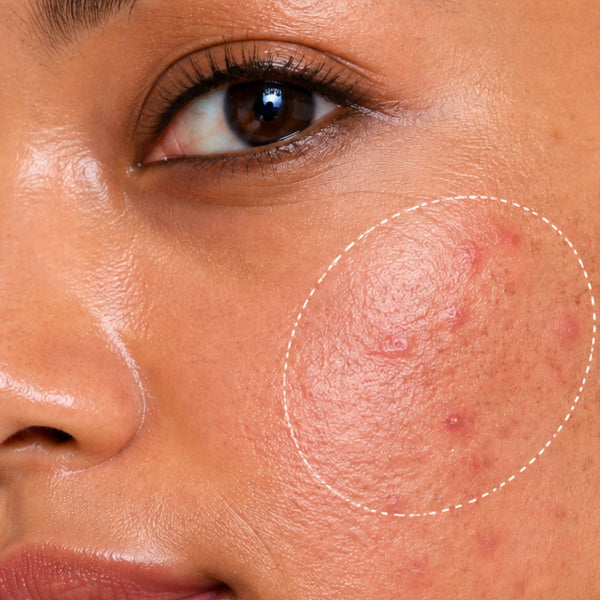 Acne & Blemish Control